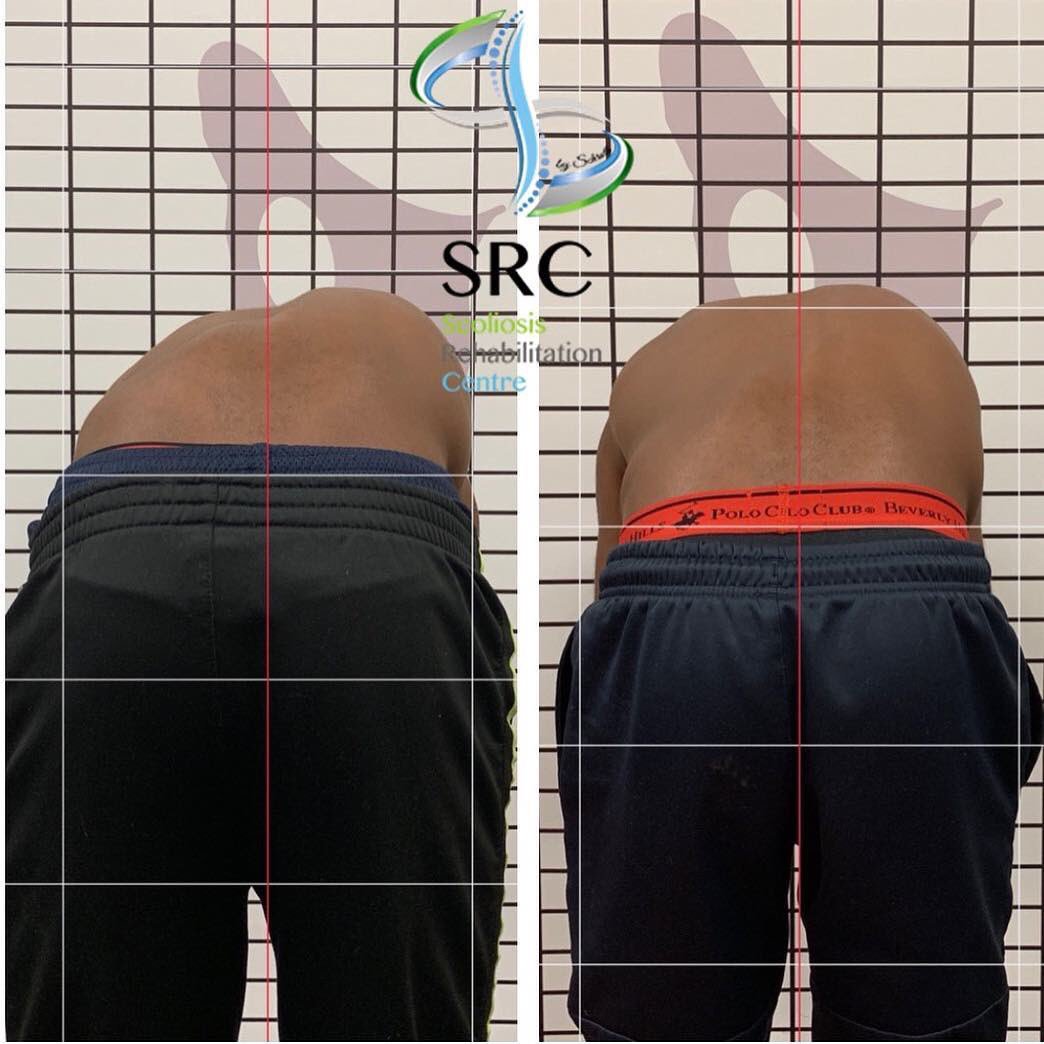 ScolioCentar's tweet image. Naši rezultati sa kampa iz Amerike! Uporan i naporan rad uvek da rezultat! Prijave za sledeću Schroth edukaciju su krenule, a prvi seo edukacije će biti odrzan od 10.04.2019.-14.04.2019. #schrothmethod #schrot #scoliocentar #scoliosisawareness #spine #isstschroth #scoliosis