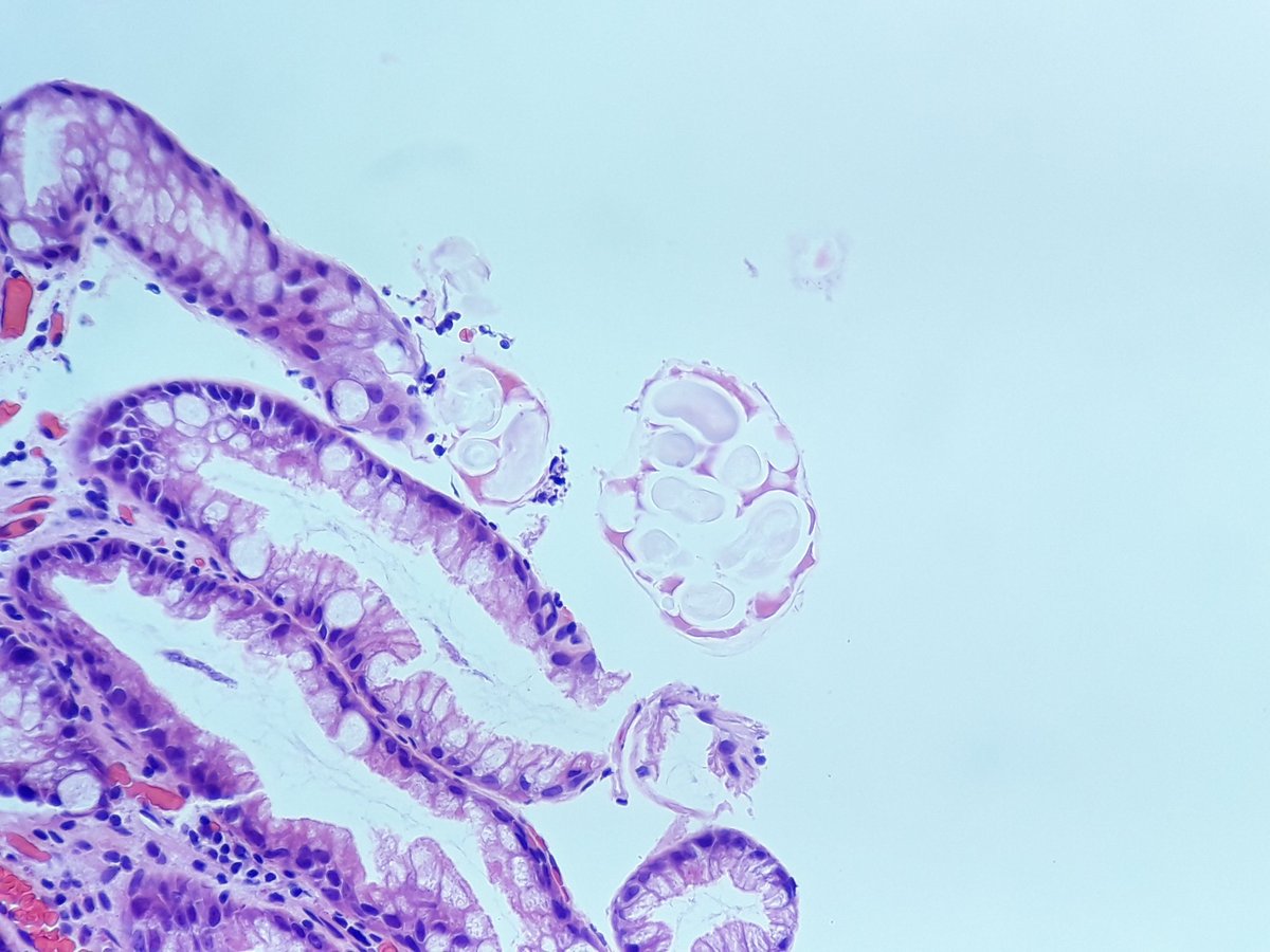 Ho_Khanh_MD's tweet photo. Surface of the colon. Do you think it's a parasite? #pathology #Gipath @TheKarenPinto @ariella8 @DraEosina @kriyer68 @slusagar @DrGeeONE @CArnold_GI https://t.co/zFzr9KaB0d