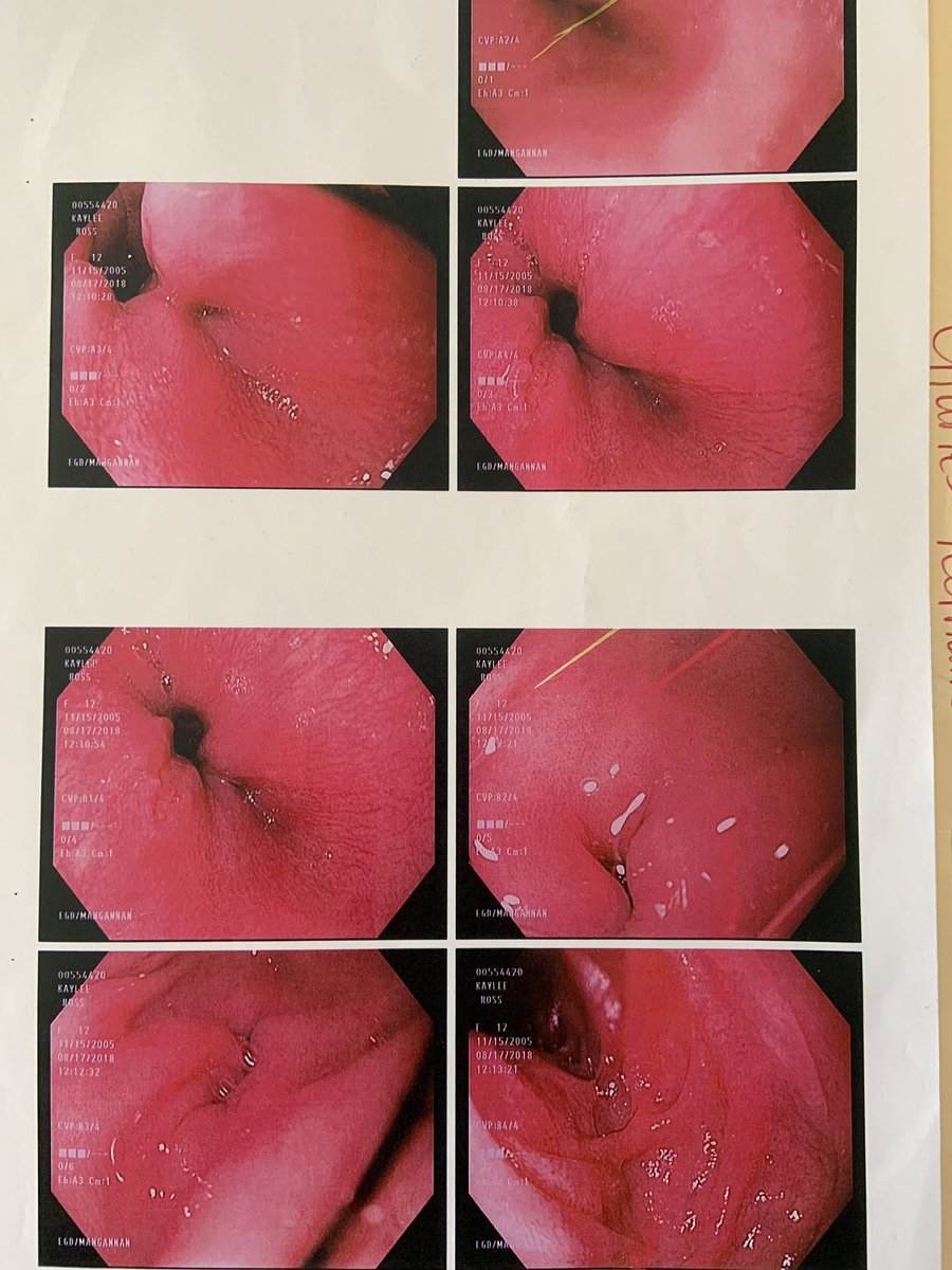This is an Esophagus after being exposed to a rotten sewer line that pushes back into a building. It is what the Spartan High Students looked like before his procedure, seeing as how the High School has this issue too@foxcarolinanews <a href="/wyffnews4/">WYFF News 4</a> <a href="/WSPA7/">WSPA 7NEWS</a> <a href="/GoUpstate/">Herald-Journal</a> <a href="/SpartanburgCity/">City of Spartanburg</a>