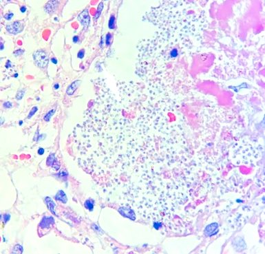 stonehenge1303's tweet image. Histoplasmosis #lung #patholo
