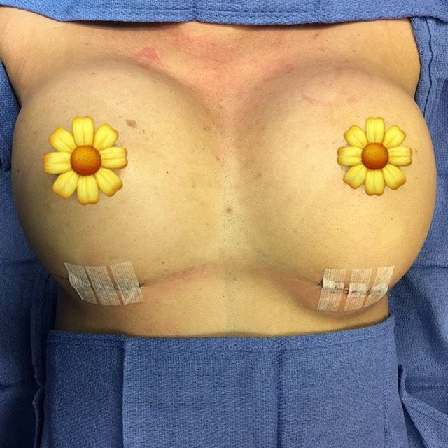 ECS_1's tweet photo. 350 CC Silicone Breast Augmentation ! 🌼✨ #ecs #cosmeticsurgery #plasticsurgery #breastaugmentation #breastimplants #boobjob #silicone #moderateplus #doctor #eastlakecosmeticsurgery #eastlake #sandiego #sandiegoimplants https://t.co/HFmhcYat1X