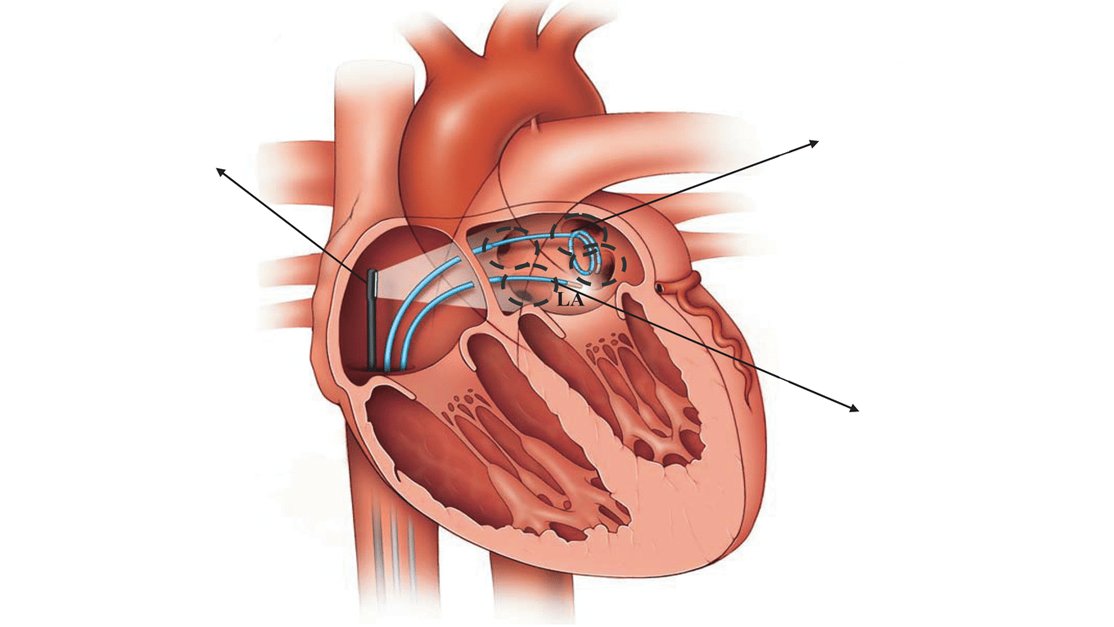 Развитие хорды человека. Дополнительная хорда левого желудочка. Хорда левого желудочка сердца. Малая аномалия сердца дхлж.