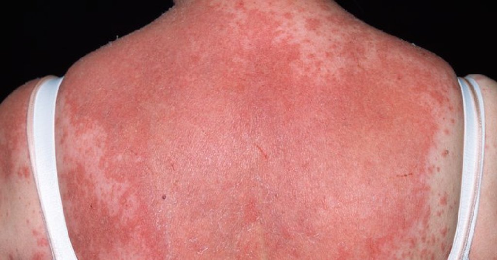 Poison Ivy Rash On Neck