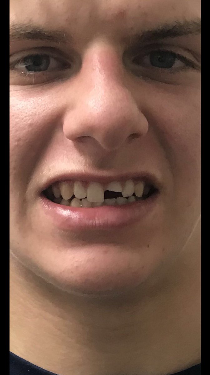 Walt broke his tooth last night and still secured the dub for the team. What a dog!!!! Catch him and the rest of the Pack Wrestling team tomorrow night for the regional semifinal and final. Location and time tbd later tonight.