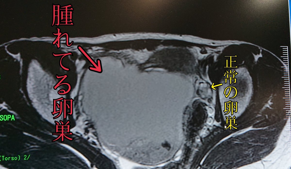 卵巣 が 腫れ てる と 言 われ た