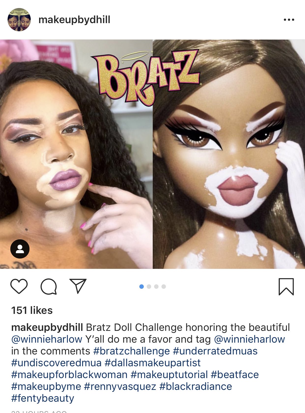 vitiligo bratz