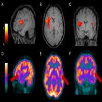 Current Issue: The Value of Regional Cerebral Blood Flow SPECT and FDG PET in Operculoinsular Epilepsy dlvr.it/QxtXZs