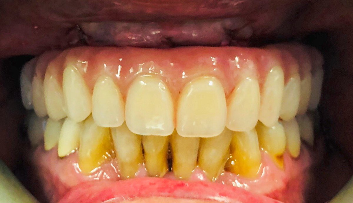 Straumann ProArch case in Amarillo, TX using Straumann’s new Smile-In-a-Box Service! Guides, Abutments, Cylinders, Models and Implants in one box!  #straumann #getsbetterfromhere #smileinabox #codiagnostix
