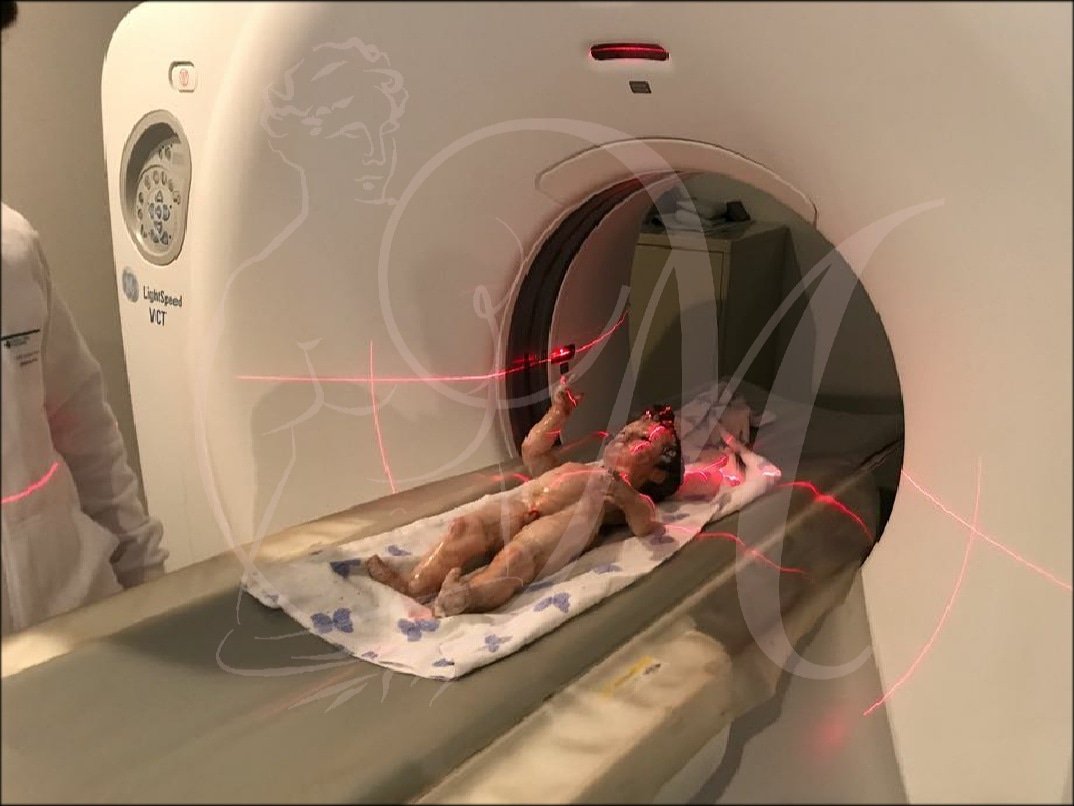 MusaeSL's tweet photo. Para un estudio más exhaustivo de la Imagen, realizamos un TAC en el Hospital Nisa.
#musae #musaerestauración #TAC #NiñoDios #patrimonio #conservación #EstudiosComplementarios #HospitalNisa #Sevillahoy #TDSCofrade #TDSActualidad #TDSCultura #ASacro #sospatrimonio https://t.co/oVyY7nw0lW