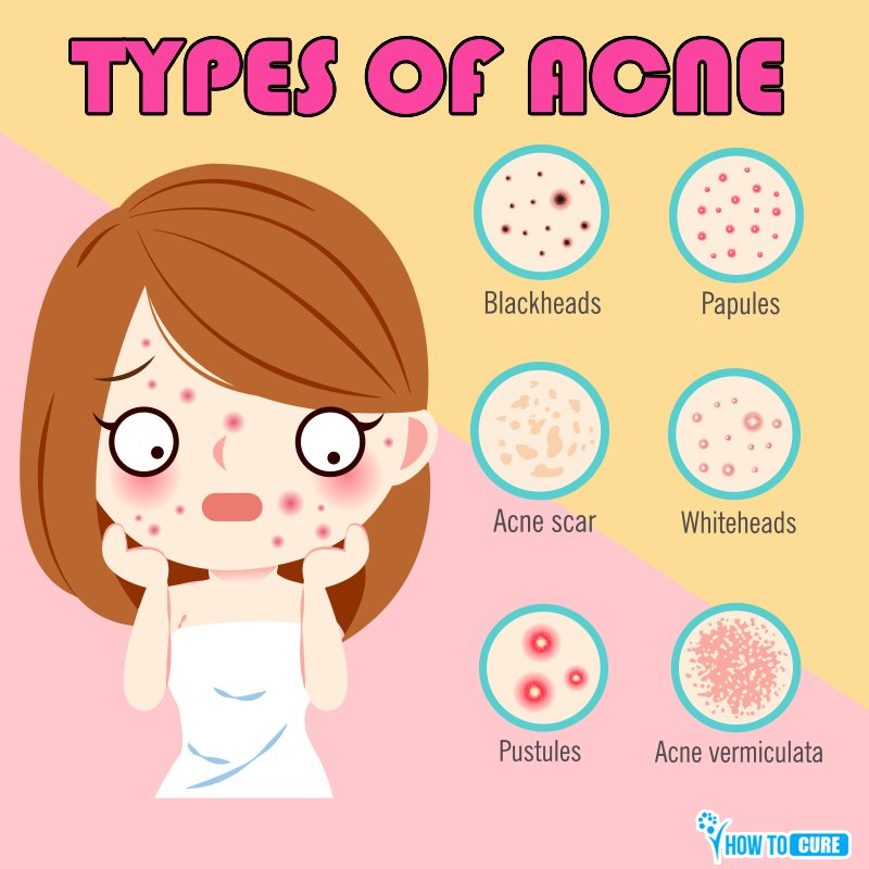 Howtocure2's tweet photo. Acne Fact:
Nearly 85 percent of people between 12 and 24 experience acne at least once.
Following are the 6 types of Acne.
#howtocure #health #beauty #beautytips #apples #apple #applepaste #apple #pimples #acne #face #skincare #skin #selfcaretips #tips #skincareroutine https://t.co/Kv4vclA1IB