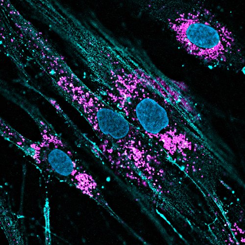 How can #mutations in a #protein that is not in the #lysosome result in a #lysosomalstoragedisorder? #CLN8 @SardielloLab @NatureCellBio @bcmhouston @TCHResearchNews bit.ly/2HIeKTl #Batten