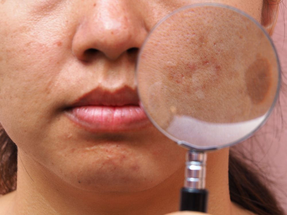 Can picosecond lasers  treat #melasma? Find out in this article. buff.ly/2CfsA9X #aesthetic #lasers
