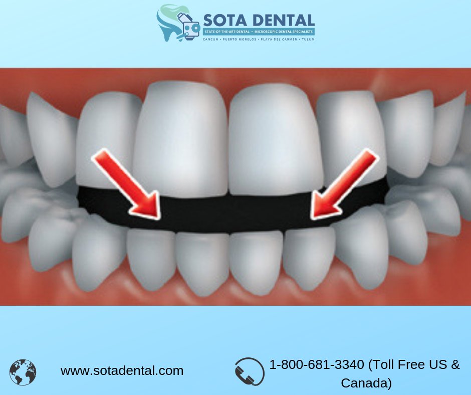 sotadental's tweet image. Open-bite Treatment in Mexico
sotadental.com/dental-holiday…
#dental #openbite #openbitetreatment #dentalhealth #oralhealth #oralhealthawareness #oralhealthcare #sotadental #sotadentalcollaborative #cancun #playadelcarmen #tijuana #losalgodones #mexico