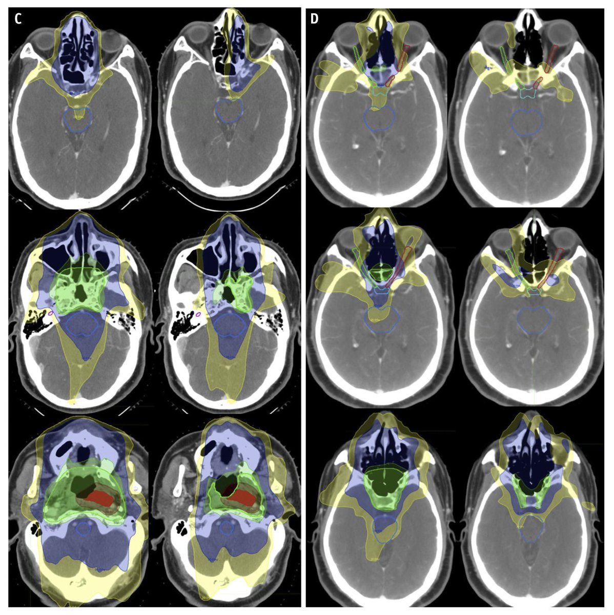 Happy (and relieved) that our manuscript on contouring for nasopharynx cancer is finally published.  It was a labor (of love?) with the one and only Dr. Annie Chan. #evilgray @MGHCancerCenter 

authors.elsevier.com/a/1YUr01Hx51~H…