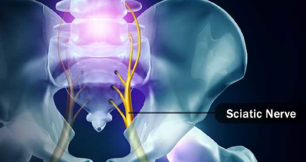 CMRBenefitsGrp's tweet photo. #Sciaticnerves go from your lower back into your legs. When something presses on them, like a #slippeddisk or a #bonespur, you get #sciatica. How to find relief: https://t.co/5sIaKQOs4t https://t.co/d5C2pjacyV #webmd #health #backpain #nervepain