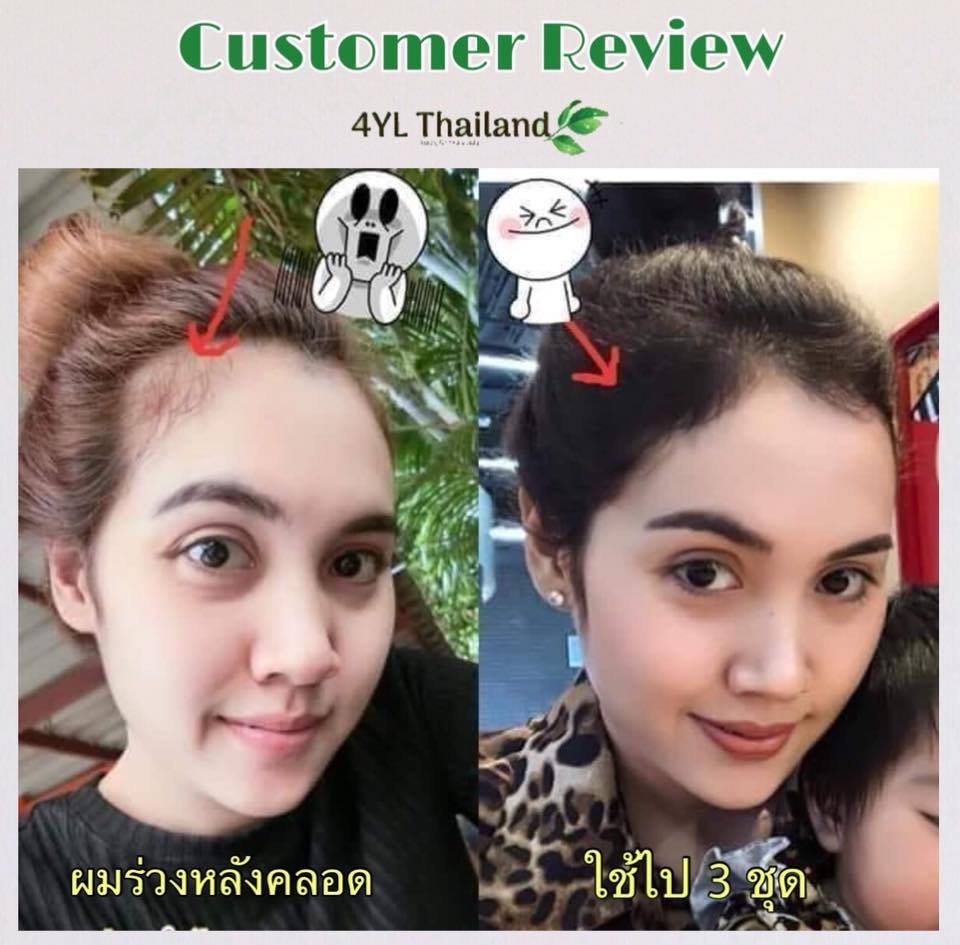 somerrissy's tweet image. ปัญหาผมร่วง..กวนใจคุณอยู่ใช่มั้ยค่ะ

ผมร่วงผิดปกติ เป็นสัญญาณที่บอกว่า... #คุณกำลังจะหัวล้าน 😢😢 ผู้หญิงเราปล่อยให้หัวล้านไม่ได้นะคะ เสียบุคลิกสุดๆ

ไม่ว่าจะร่วงหลังคลอด ร่วงเพราะผมมัน ร่วงเพราะแพ้เคมีหรือแชมพูทั่วไป

❌ หยุดผมร่วง ❌ ✅ เร่งผมเกิดใหม่ ✅ ด้วยแชมพูสมุนไพร4YL