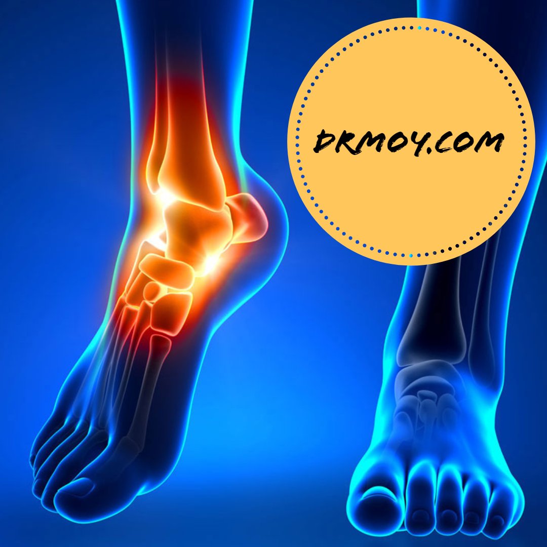 We treat many ankle disorders including: fractures, tailor dome lesions, synovitis, arthritis and loose bodies. Ankle arthroscopy is a procedure that is highly successful and minimally invasive, which would allow a patient to resume normal activity quickly.  #Anklearthroscopy