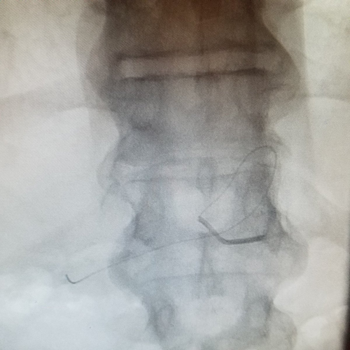 keithppereira's tweet image. A #PedalLoop can #SaveALimb 
A #GastricLoop can #SaveALife 

Trust an #Irad with either or both!

#Radialfirst coiling of right gastric via left gastric to allow delivery of #RadiationTherapy to treat #LiverCancer

@SIRspecialists @SIRRFS
@BSIR_News @kmadass @LessneVIR @bonesz