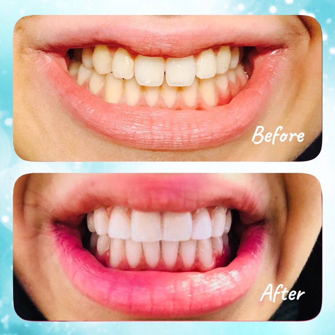 LevenshulmeDen2's tweet image. #sixmonthsmiles #6monthsmiles #smilemakeover #straightteeth #teethwhitening #compositebonding #instasmile #invisalign #dentist #dental #dentistry #whitewires #clearbraces #smile #straightsmiles #dentistmanchester  #levenshulmedentist #levenshulme #didsbury #stockport #manchester
