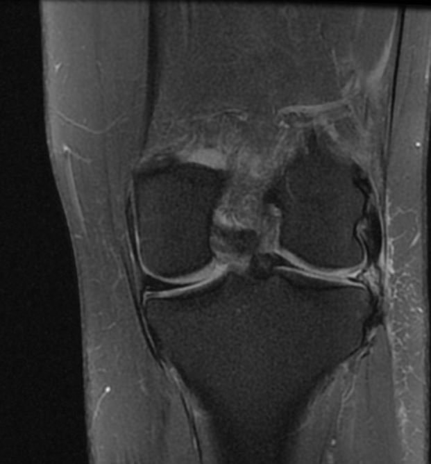 Santiago Arauz (@arauz_santiago) on Twitter photo Signo denominado del "fast forward" (⏩⏩⏩⏩)  por mi amigo <a href="/DrRaulTorres/">Cadera y Rodilla</a> para describir la imagen de un asa de cubo de #menisco (en este caso externo) en los cortes sagitales de resonancia. No está ✍ publicado (creo) pero seguro que no se os olvida Signo denominado del "fast forward" (⏩⏩⏩⏩)  por mi amigo <a href="/DrRaulTorres/">Cadera y Rodilla</a> para describir la imagen de un asa de cubo de #menisco (en este caso externo) en los cortes sagitales de resonancia. No está ✍ publicado (creo) pero seguro que no se os olvida