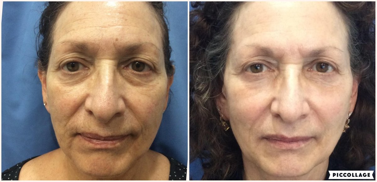 NaturalLookFL's tweet photo. Amazing results after combination of IPL, Non-ablative Laser, and Dermal Fillers by our Amanda Peacock, ARNP

#ThreeForMe #IPL #Laser #DermalFillers #NonInvasive https://t.co/ul1RjeAf7t