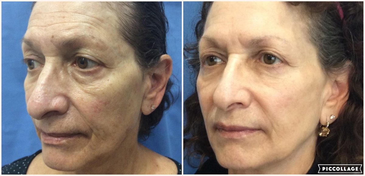 NaturalLookFL's tweet photo. Amazing results after combination of IPL, Non-ablative Laser, and Dermal Fillers by our Amanda Peacock, ARNP

#ThreeForMe #IPL #Laser #DermalFillers #NonInvasive https://t.co/ul1RjeAf7t