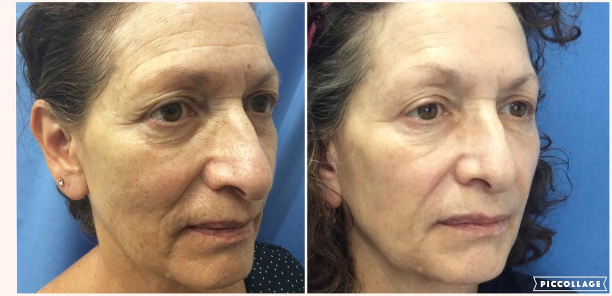 NaturalLookFL's tweet photo. Amazing results after combination of IPL, Non-ablative Laser, and Dermal Fillers by our Amanda Peacock, ARNP

#ThreeForMe #IPL #Laser #DermalFillers #NonInvasive https://t.co/ul1RjeAf7t