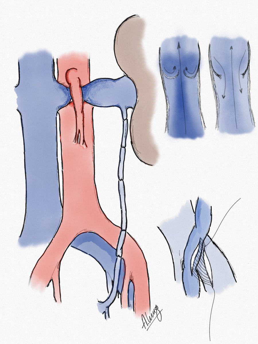 A world-first procedure at SickKids! A team of surgeons changed blood flow in a vein from one-way to two-way in minimally invasive and life-changing procedure for teen: ow.ly/GE8I30ny3Qa