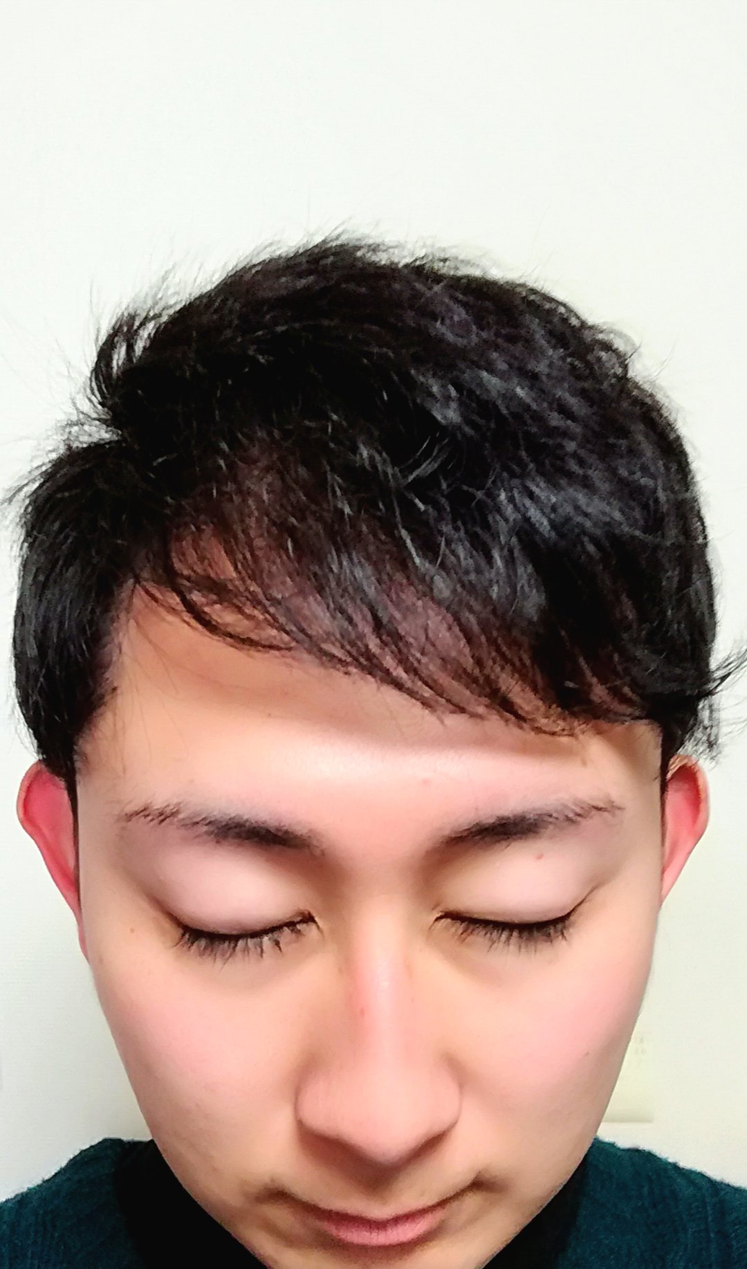 ハゲリーマンちゃんねる 毛髪診断士 ハゲ対策系youtuber 18年5月 中国でm字部分に植毛して来ました 9ヶ月の 髪型です 美容室にも月1回通っています 経過観察 8ヶ月 スタイリング セット 分け目 髪型 Aga Aga対策 自毛植毛 植毛 ハゲ M字