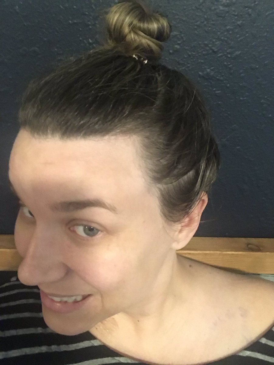 howishayley's tweet photo. when your man fixes your bun. #messyhairdontcare #youngbreastcancer #breastcancer #brca #howishayley #postop #mastectomy https://t.co/qmcx0Yr123