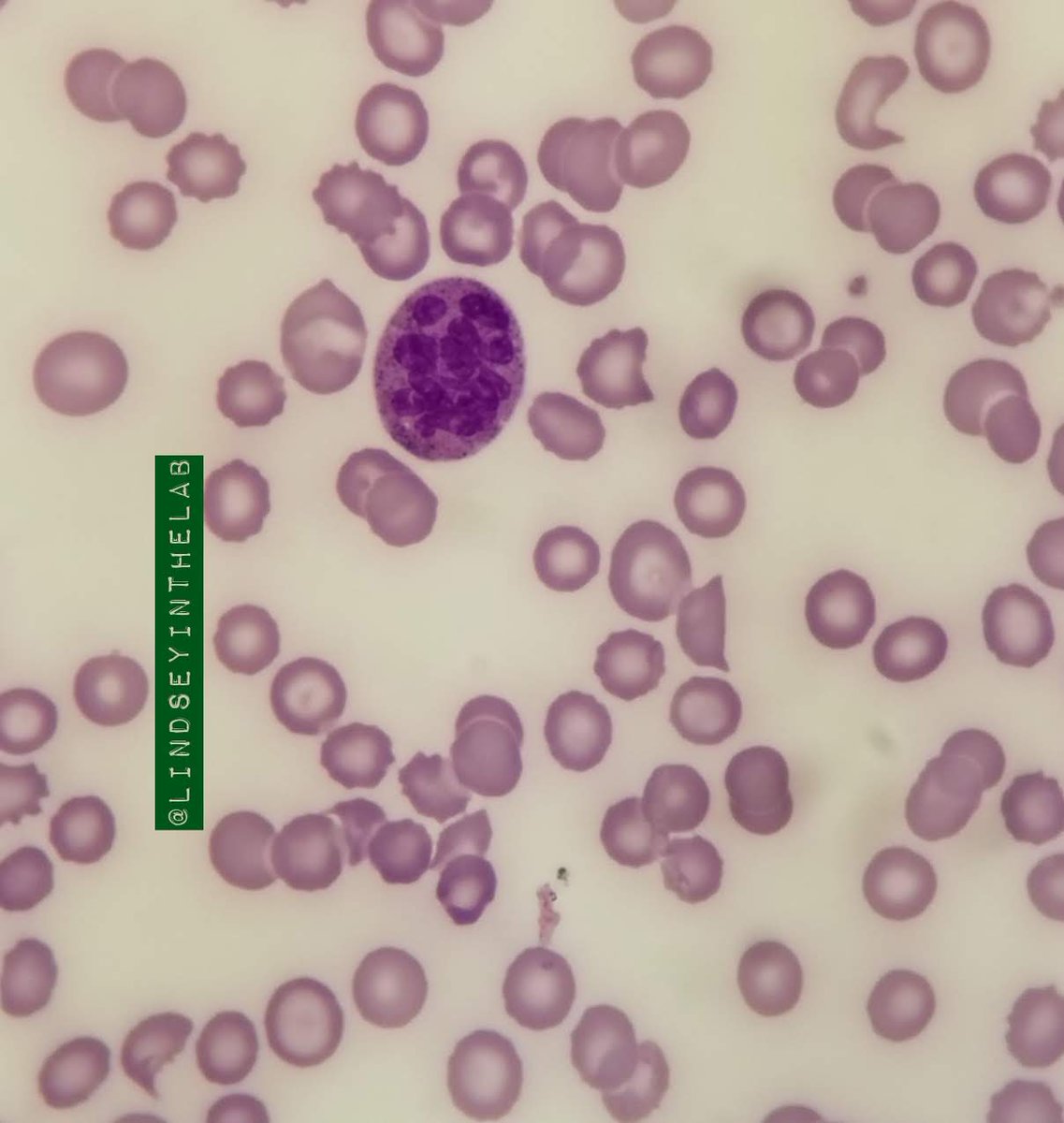 Hypersegmented Neutrophils