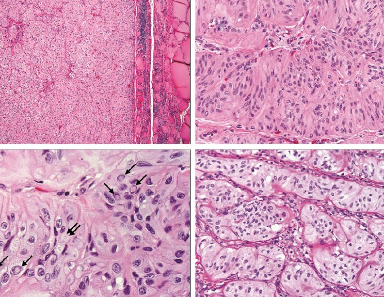14 hyalinizing trabecular adenomas positive for GLIS fusions, including 13 PAX8/GLIS3 and 1 PAX8/GLIS1. None of 700 PTCs had PAX8-GLIS3  fusion liebertpub.com/doi/abs/10.108…