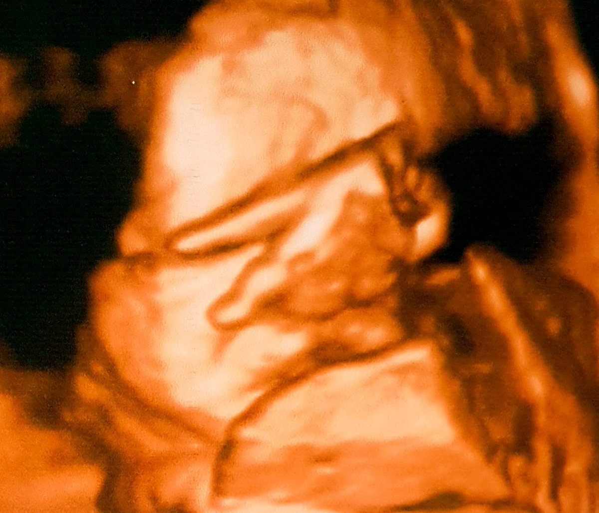 As much as you want to plan your life it has a way of surprising you with unexpected things that will make you amazed. 
36weeks today, we're good✌🏻