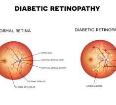 في دراسة بمجلة Clinical and Experimental Ophthalmology توصلت الى ان شرب  الصودا 'الدايت' يزيد من مخاطر الإصابة بأمراض اعتلال الشبكية السكري وهو احد مضاعفات داء السكري  وكشفت ان الذين يستهلكون حوالى 1.5 ليتر من المشروبات الغازية الدايت بالأسبوع اكثر تعرضا
onlinelibrary.wiley.com/doi/pdf/10.111…