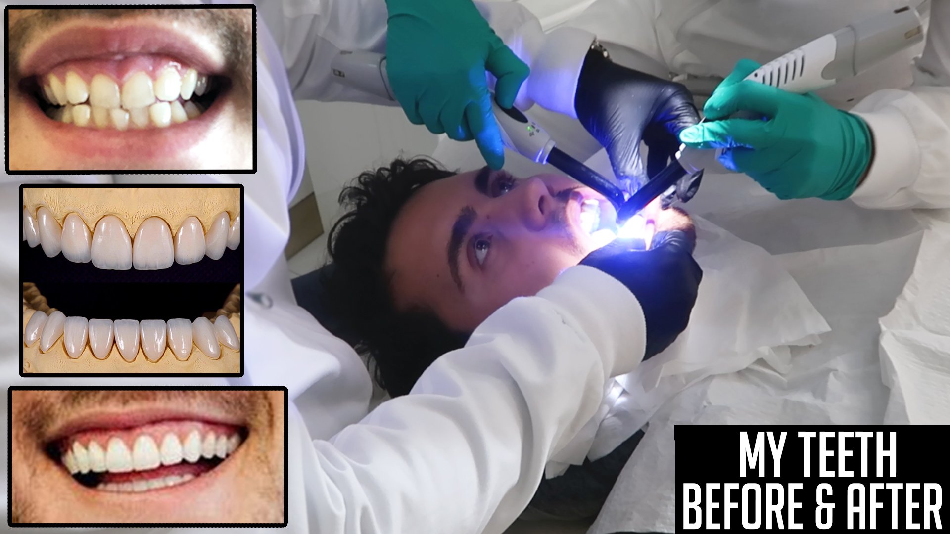 Alfie Deyes on Twitter "My Teeth Before & After (Laser Gum Surgery
