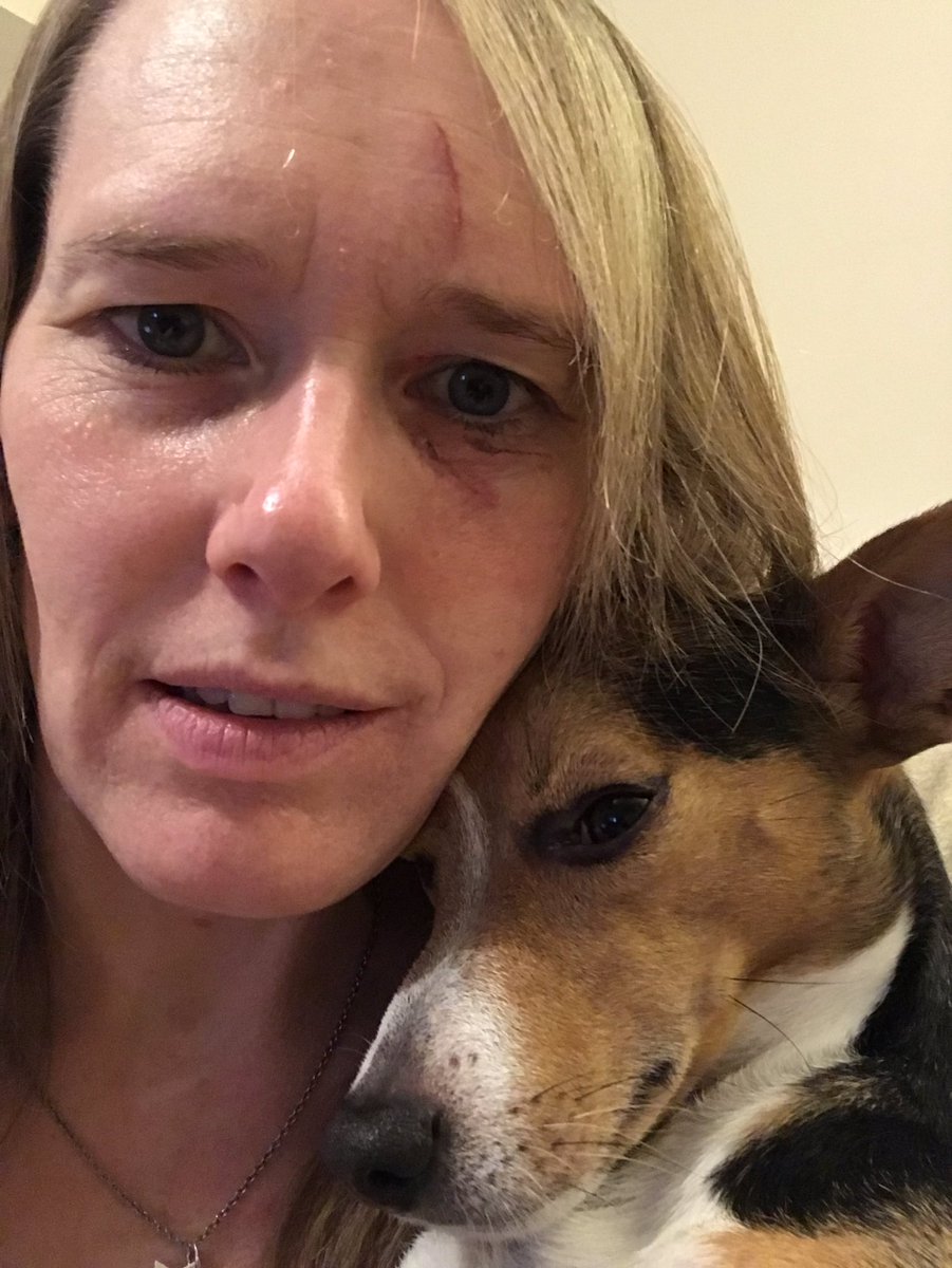 JackJackJRT's tweet photo. I 🐶 think it looks 👀 lovely & colourful 🌈👁 Mummy 👩🏼 isn’t so keen 😏 #ouch #dog #dogscratch #hurtmummy #sorry #iamsorry #bruise #accident #hurt #jackjack #jackjackjrt #jackrussell #jackrussellterrier #jackrussellcross #crossbreed #dogofinstagram #dogsofinstagram #dogoftwitter https://t.co/vqdQ8uXUfv