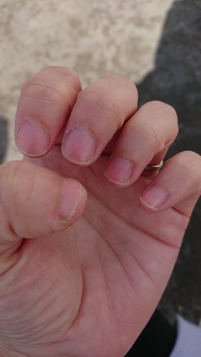 ネイルバイター 爪噛み克服 Nail Biter7 Twitter