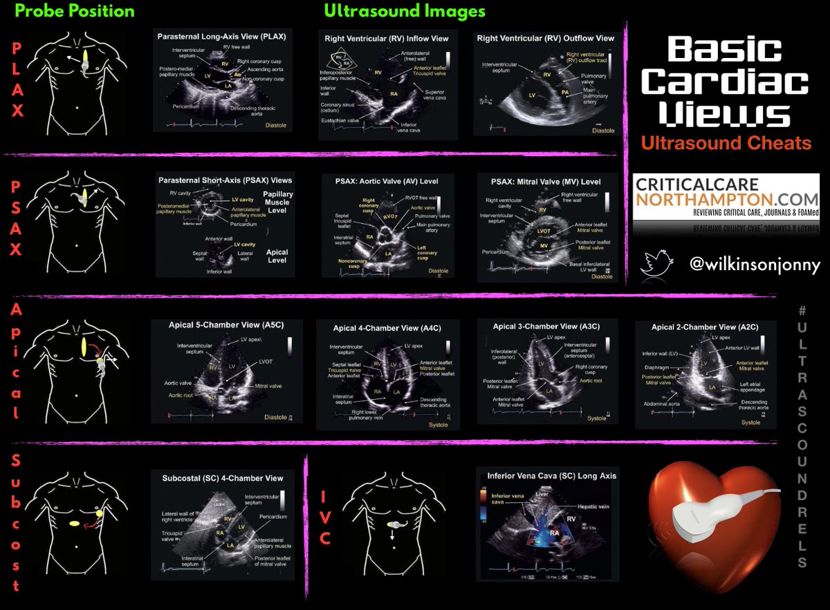 Basic #POCUS Cardiac Views by <a href="/Wilkinsonjonny/">Jonny Wilkinson</a>:

criticalcarenorthampton.com/pocusgrams/

#FOAMed #Meded images made searchable:

"TTE windows" -&gt; grepmed.com/?q=TTE+windows