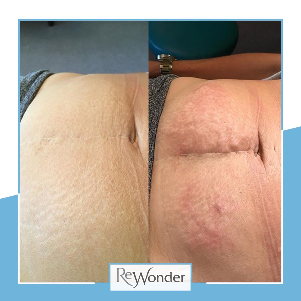 Wondertoots's tweet photo. #Carboxytherapy is a safe and non-invasive #treatment designed to #rejuvenate, #restore and recondition the #skin by tackling #wrinkles, #cellulite, laxity and even #StretchMarks.

Want to get booked in for this treatment?

01484 423023
https://t.co/7WemtDAhsX

#ReWonder https://t.co/gjiQ3bBxgW