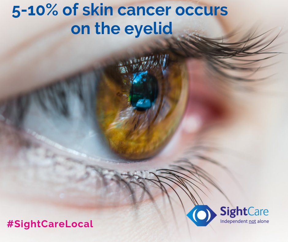 BOpticians's tweet photo. It's World Cancer Day and a staggering 5-10% of skin cancer can be found on the eyelid. Ensure you have your eyes tested at least every two years and report any changes to your optician. 
#WorldCancerDay #SkinCancer #EyeSafe #EyeHealth  #SightCareLocal https://t.co/AiVkGEcQkS