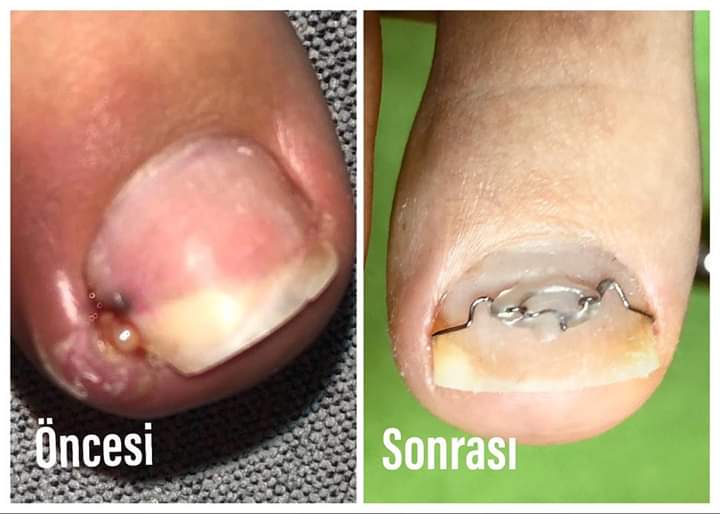 Üçüncü seansına gelen hastamıza tekrar tel uygulamasına gerek duymadık,bu kadar kısa sürede kaydettiğimiz ilerlemeye hastamız inanamıyor 🤗 #podoloji #podologie #podologia #podolog #ayaksağlığı #medikalayakbakımı #ayaksağlığımerkezi #ayaksagligiizmir #tırnakbatması