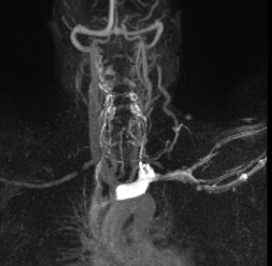 VictorSuarez_Rx's tweet photo. Importance of #TWIST dynamic angiographic sequence for Outlet Thoracic syndrome.#3Tesla
Normal "hands down"
"Hands up" angio depicts bilateral subclavian compression in interscalen notch. Delayed venous angio shows left collateral circulation. Supraclavicular lipoma on T1. https://t.co/eii0PBXlTp