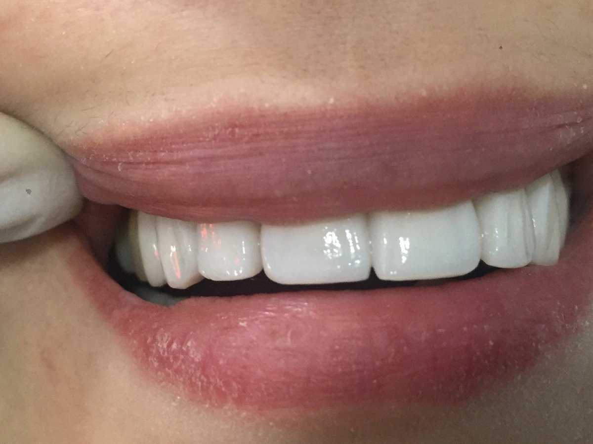drhaddads's tweet photo. Smile makeover https://t.co/YVel8PLM4a