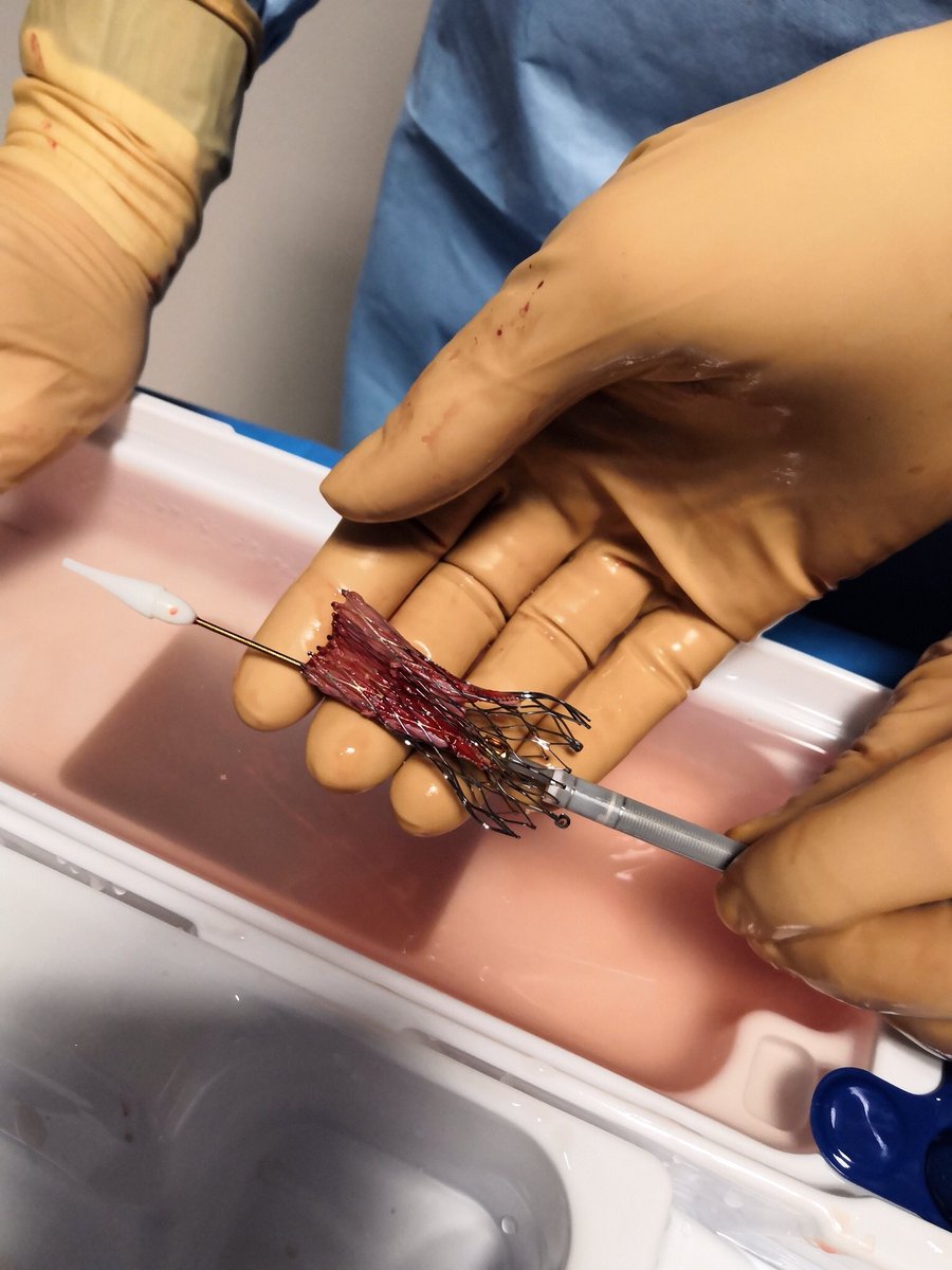 Did you know that recapturing corevalve Evolut pro is not always easy ?! In this case, stent frame misdeployment was visible so we decided to recapture. After 2  unsuccessful attempts, valve was retrieved showing us a misloading that happened at the first recapture #TAVR