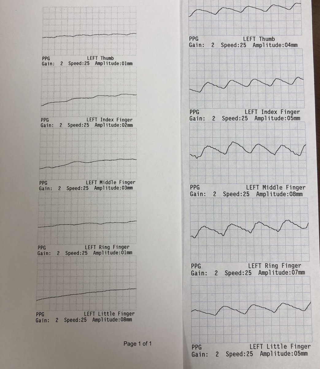 High flow AVG with ischemic steal, severe persistent rest pain and paresthesia. Before/after proximalization of arterial inflow (PAI), now with palpable radial pulse and resolution of symptoms. #VascularSurgery #dialysisproblems #dialysis