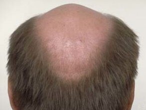 Slow_n_Lazy's tweet photo. Pray for @ColeScroggins his hairline is receding and receding fast. https://t.co/sAOl3lzicl