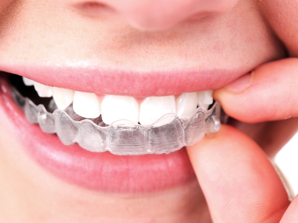 AndrewBachour's tweet photo. Invisalign is the modern way to get the fantastic smile you have always longed for without the look of braces. https://t.co/8Xcdw2ku5z