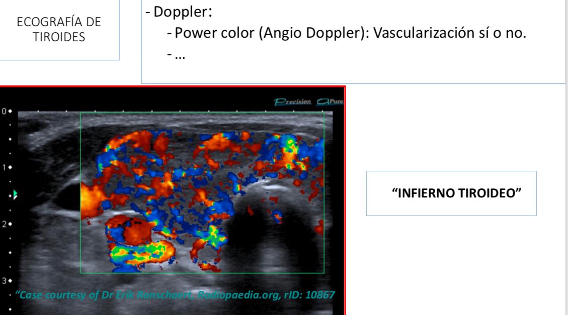 EndocrinoHUVR's tweet photo. 🔝Sesión: Enfermedad #GravesBasedow
Guía ETA 2018
✔️ Antes de retirar antitiroideos, Ac antiTSH negativos
✔️opción tras recaída: antitiroideos a bajas dosis
✔️Utilidad Eco-doppler en diagnóstico
#Endohuvr
@HospitalUVRocio Gracias @diegojds22 Dra. Romero
https://t.co/MxjQyi61kh https://t.co/zFpHQPnGRy