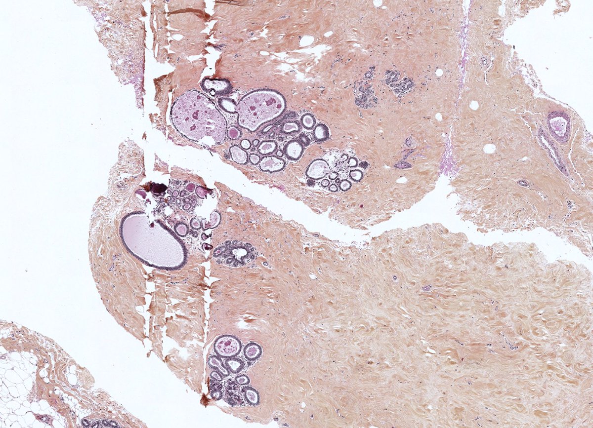 Tenonhospital's tweet photo. #breast #pathology apocine metaplasia and cystic features in a macro#biopsy https://t.co/7J30DIcutS