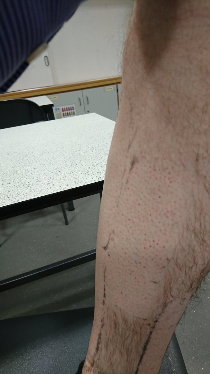 The results of the leg wax. Pain! 😭 <a href="/DHS_Hartfell/">Hartfell</a> #charityday